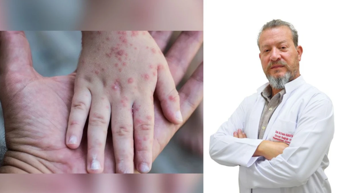 &Ccedil;ocuk Doktoru Yasin Karataş&rsquo;tan Kızamık Uyarısı